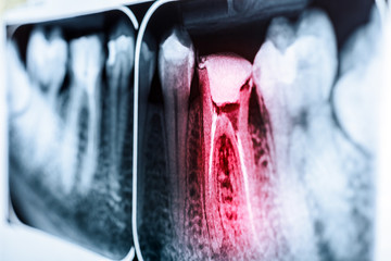 Pain Of Tooth Decay On Teeth X-Ray - obrazy, fototapety, plakaty