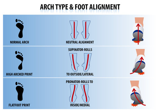 Arch Type and Foot Alignment