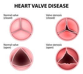 heart valve disease