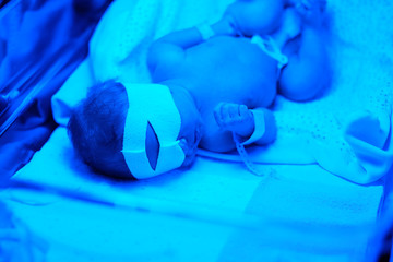 Newborn baby having photo theraphy