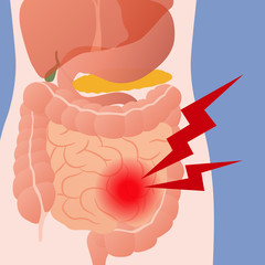 inflammation of the intestine and human digestive organs, vector illustration