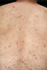 Boy with problematic skin and acne scars in the back