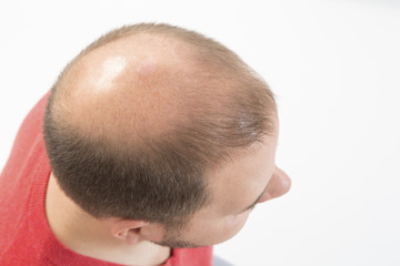 Premature baldness, man, 40s, white background