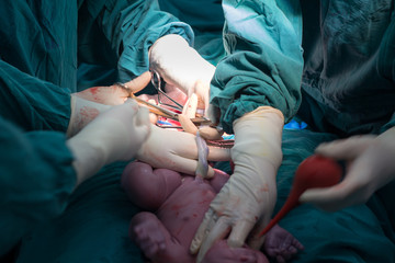 cesarean