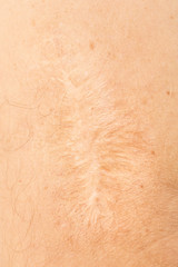 Arm with big scar