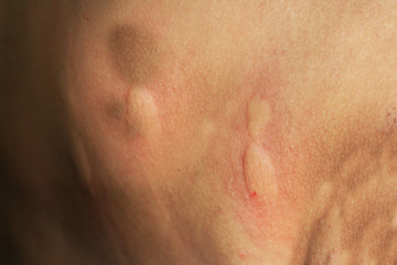 Fototapeta premium Spider bite