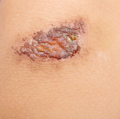Fototapeta premium wound on skin