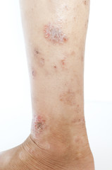 Naklejka premium Eczema rash wound on kid's calf