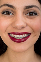 Fototapeta premium portrait of girl with dental braces