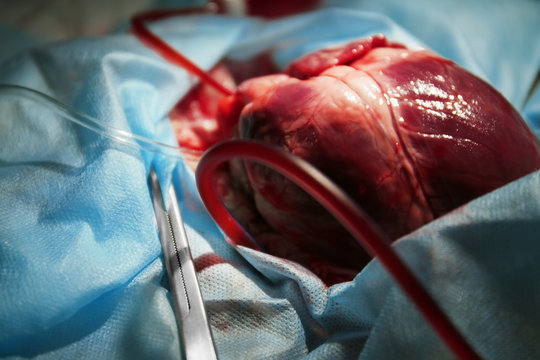 Heart ready for operation