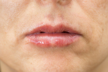 Closeup of woman swelling lips after treatment
