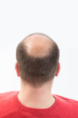 Obraz premium Chute de Cheveux Homme