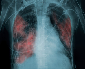 X-ray picture of a patient with lung pathology