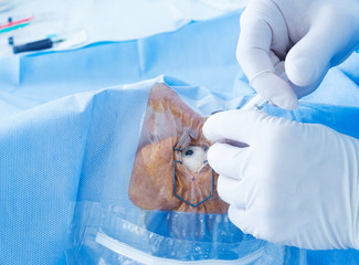 Eye surgery
