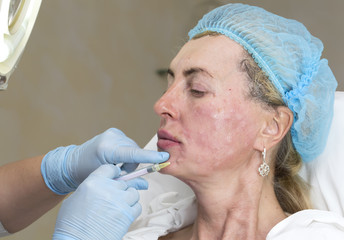 Cosmetic treatment with injection in a clinic