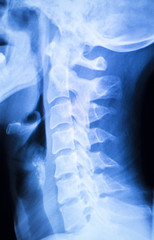 Kneck and spine injury x-ray scan