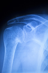 Shoulder injury orthopedics xray scan