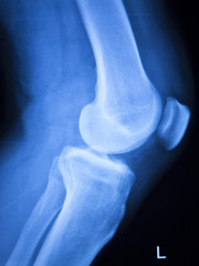 Knee joint meniscus x-ray test scan