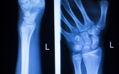 Hand finger thumb hospital xray scan