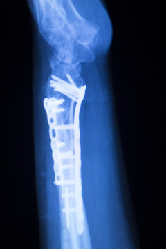 Hand orthopedics xray scan