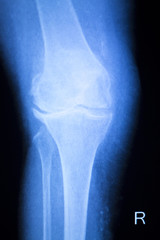 Knee joint meniscus x-ray test scan