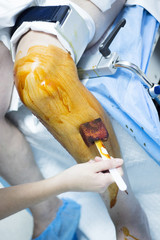 Knee arthroscopy orthopedic surgery operation