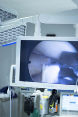 Hospital surgery arthroscopy operation screen