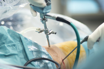 Orthopedic surgery meniscus operation