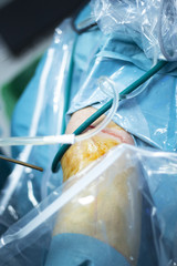 Knee arthroscopy orthopedic surgery operation