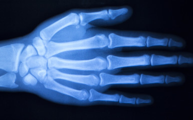 Hand finger thumb hospital xray scan