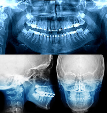x-ray with dental braces, orthodontic treatment