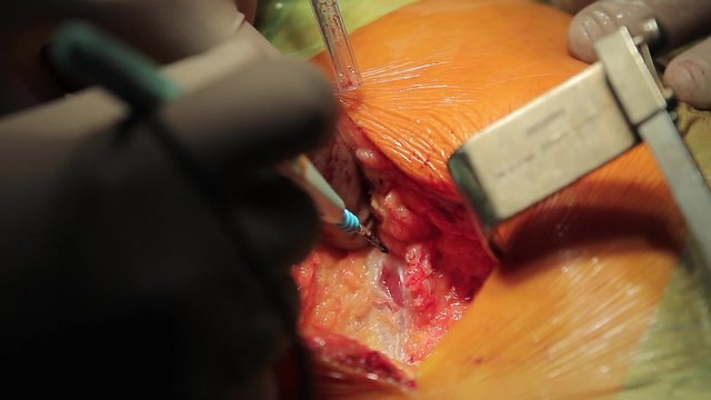 Slicing through flesh

Surgeon slicing the flesh to get to the muscle with electrosurgical scalpel (CU)