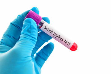 Obraz premium Blood sample for Scrub typhus test 