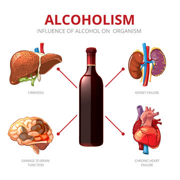 Long-term Effects Of Alcohol. Organism Function And Brain Damage, Failure Kidney Illustration. Alcoholism Vector Infographic