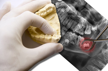 hand show molar tooth and toothache wisdom tooth