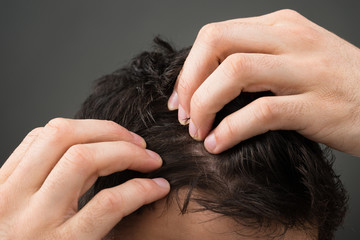 Cropped Image Of Man Suffering From Hair Loss