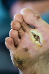 infected wound of diabetic foot