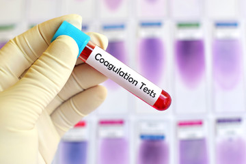 Blood sample for coagulation testing
 - obrazy, fototapety, plakaty