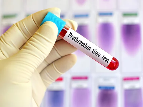 Blood sample for prothrombin time test (Blood coagulation testing)