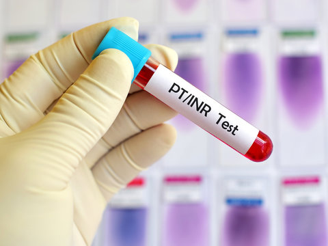 Blood sample for PT/INR test (Blood coagulation testing)
