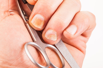 Fingernails with nail fungus