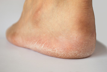 heel cracked of foot