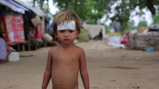 cambodian injured kid in slums in phnom penh city