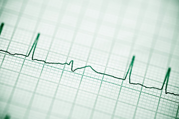 Electrocardiogram