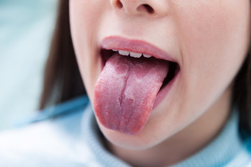 Geographic tongue