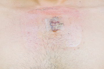 Wound from surgery