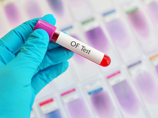 Fototapeta premium Blood for osmotic fragility (OF) test
