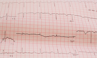 ecg graph, Electrocardiogram ecg