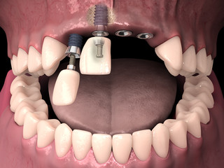 Dental anatomy - Upperr incisors with bone structure, teeth, gum and dental implants © lightmachine