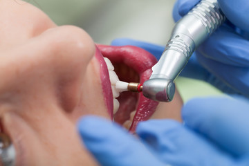 Close-up medical dentist procedure of teeth polish